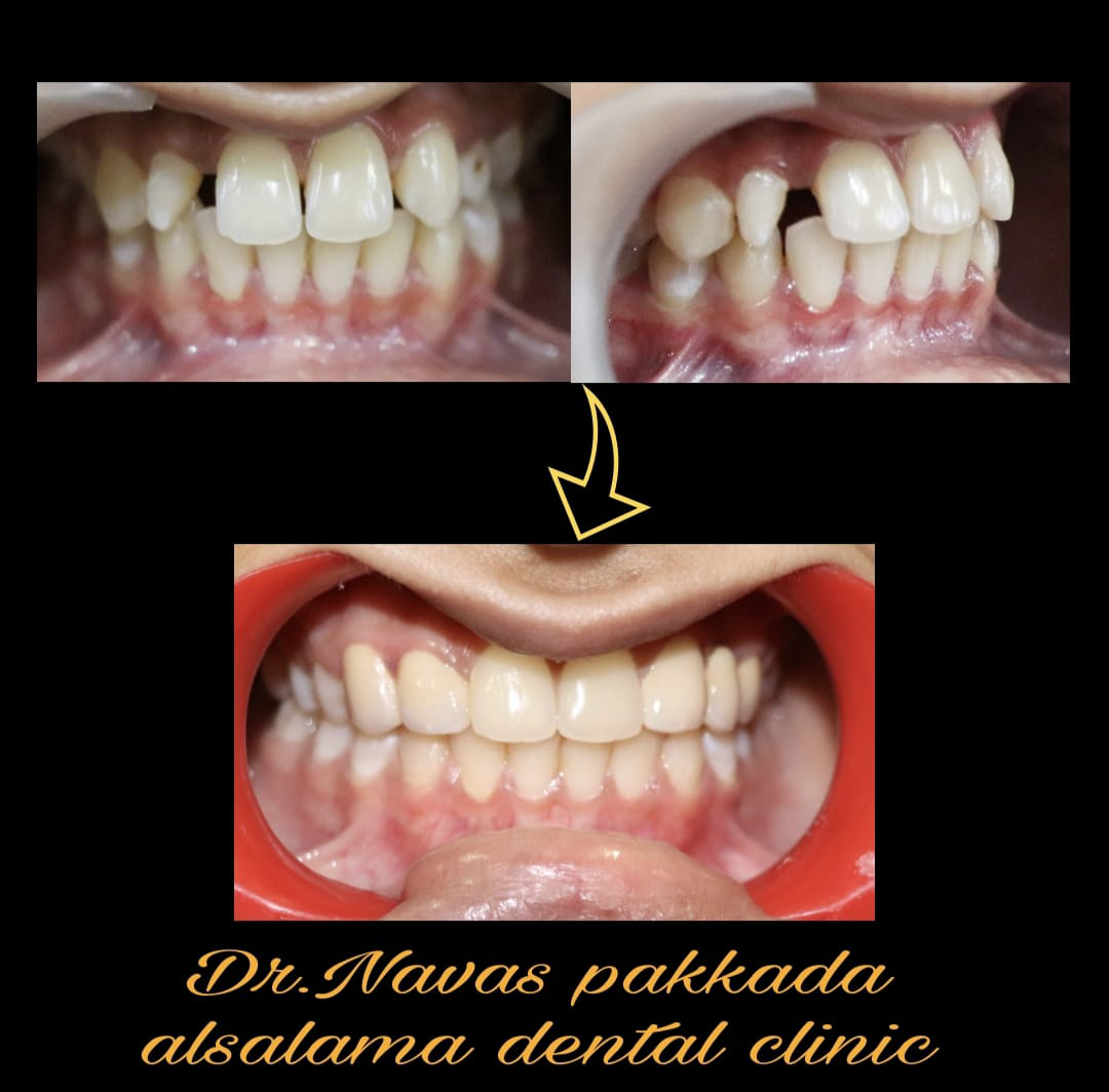 Smile designing